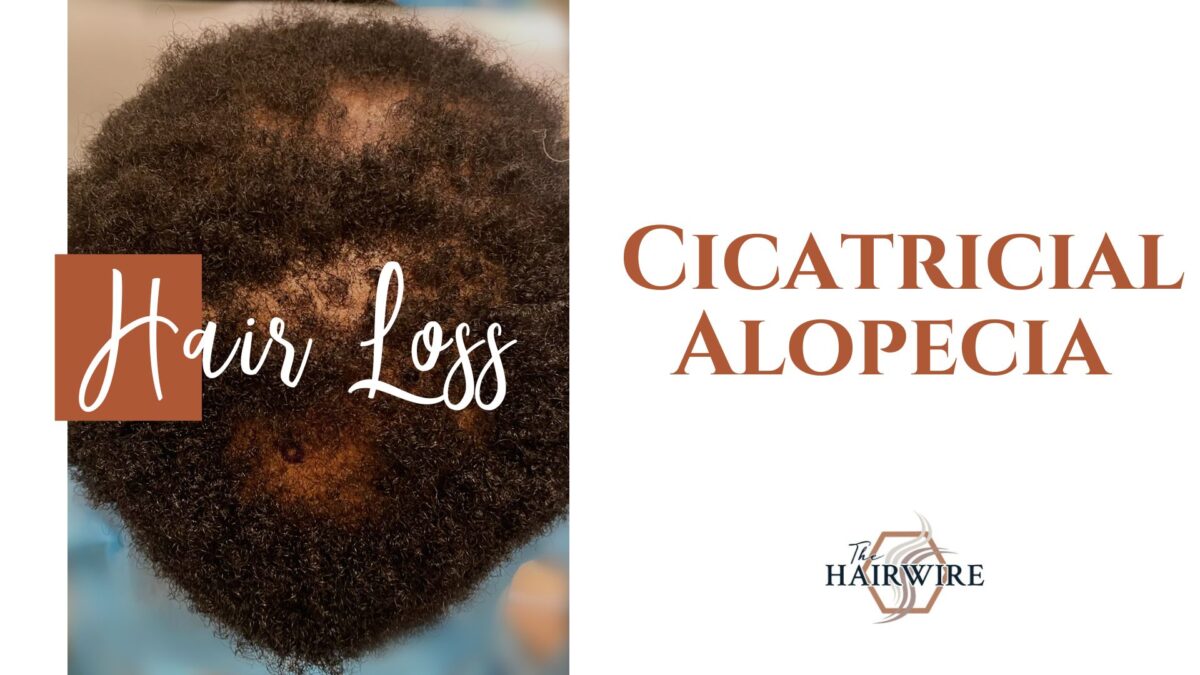 Featured image for “Cicatricial Alopecia”
