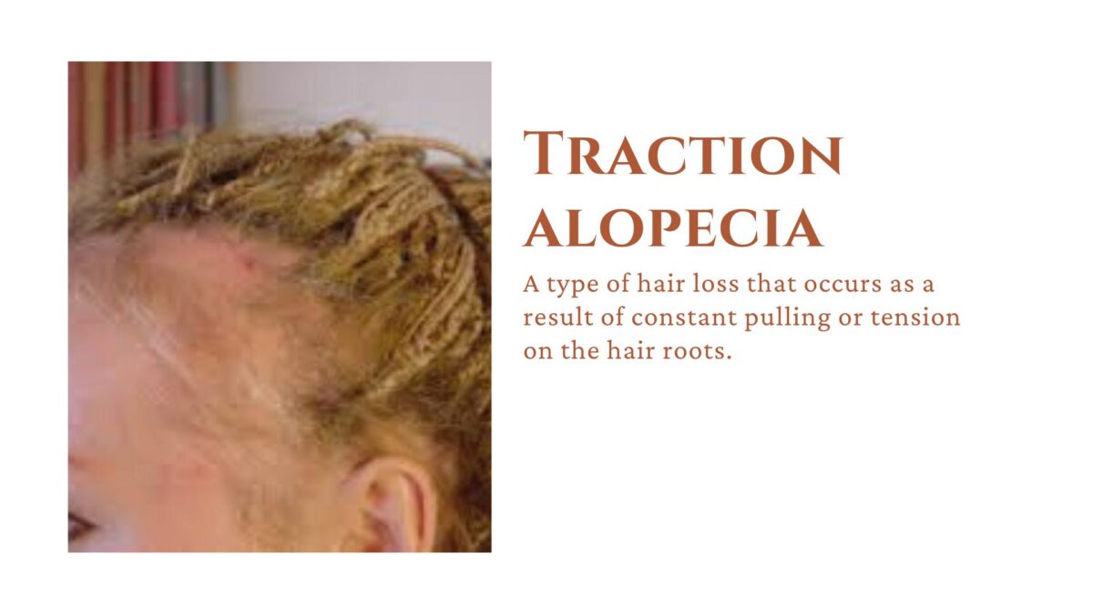 Featured image for “Traction Alopecia”